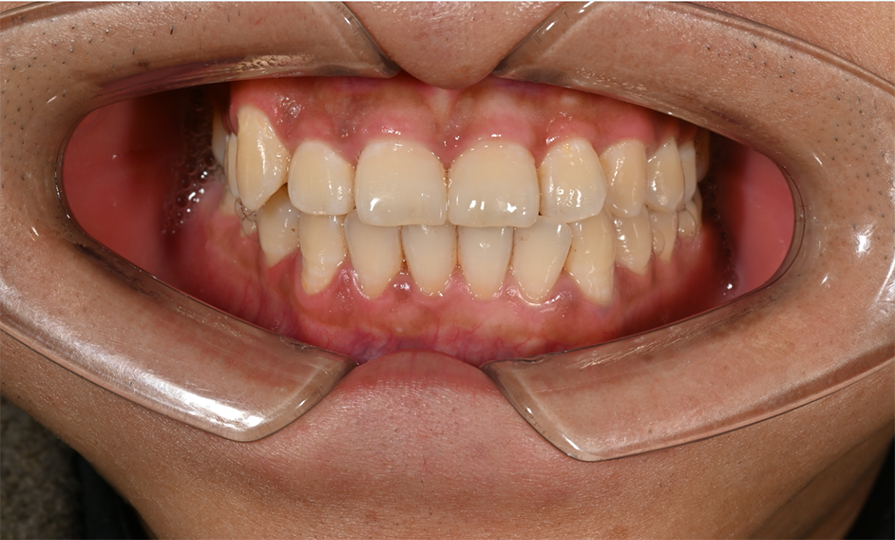 病例分享 | 微创贴面修复前牙间隙