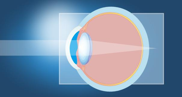 ○ 视网膜不等像——光学、视网膜感知共同影响