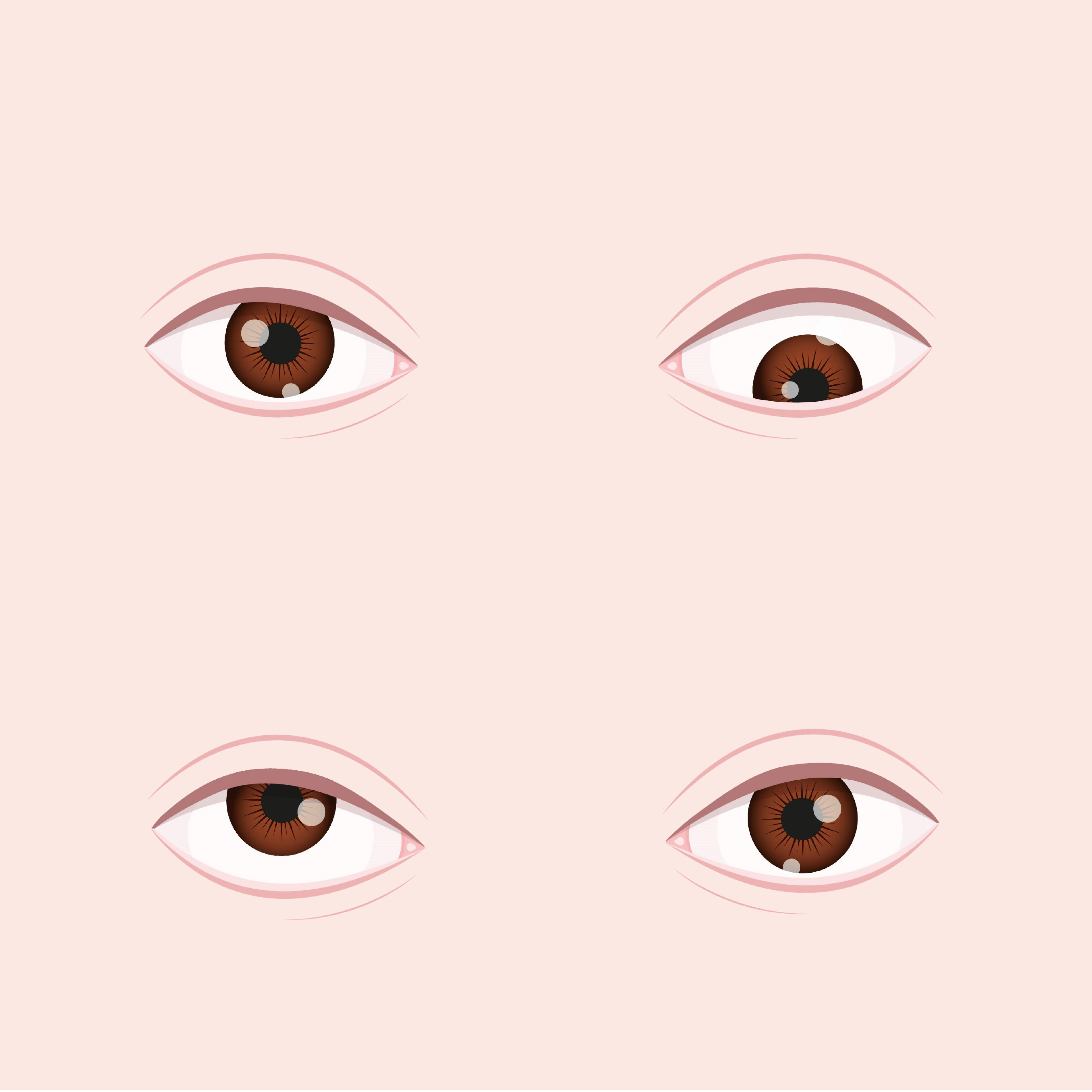 斜视是近视性屈光参差的最大风险