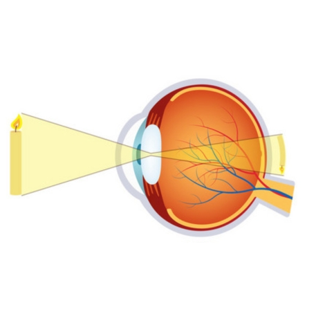 探究儿童近视的原因和最佳矫正方式讨论：晶状体与视网膜亮度